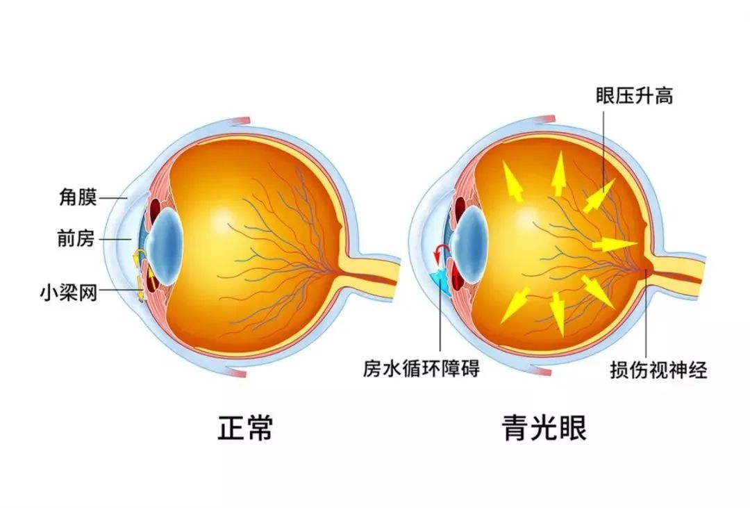 青光眼，正常